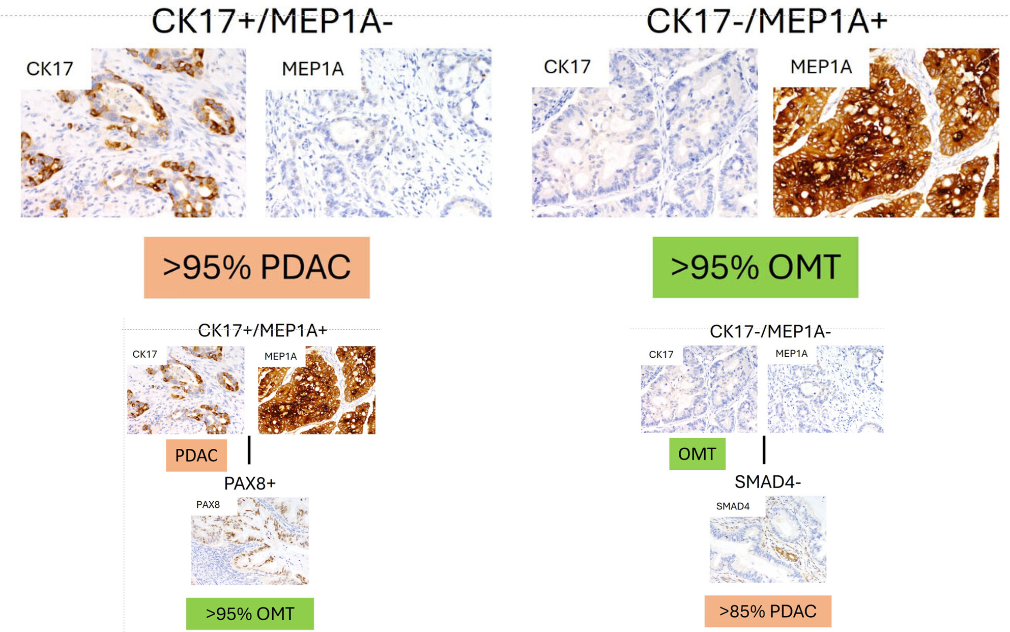 A 5-marker immunohistochemical panel of CK17, MEP1A, PAX8, SMAD4, and CDX2 to distinguish ovarian mucinous carcinoma from metastatic pancreatic ductal adenocarcinoma